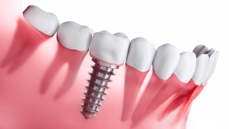 Dental Implants Salina, KS