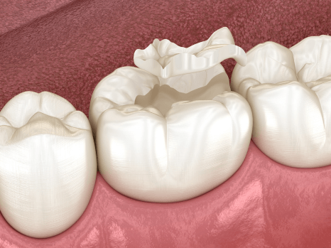 Dental Sealants in Salina, KS